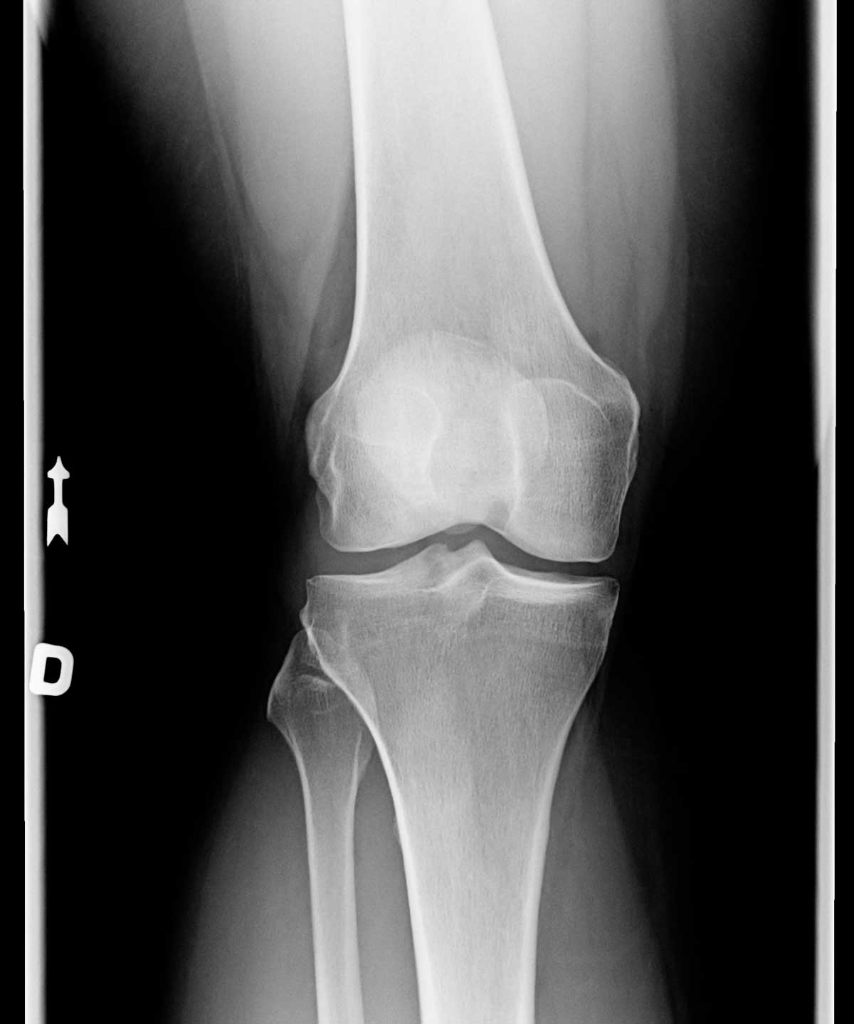 Infezione della protesi di ginocchio